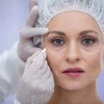 Double Eyelid Surgery