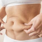 Coolsculpting