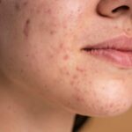 Hyperpigmentation