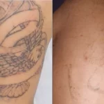 Can Tattoos Be Completely Removed