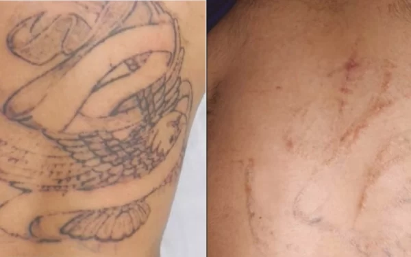 Can Tattoos Be Completely Removed