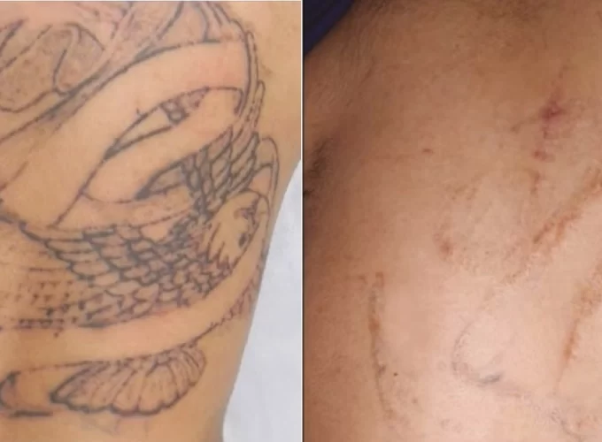 Can Tattoos Be Completely Removed