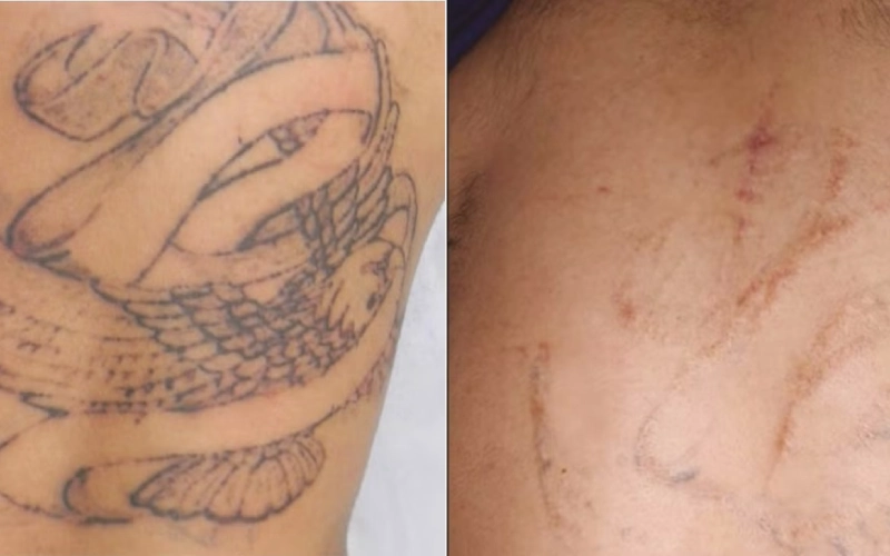 Can Tattoos Be Completely Removed